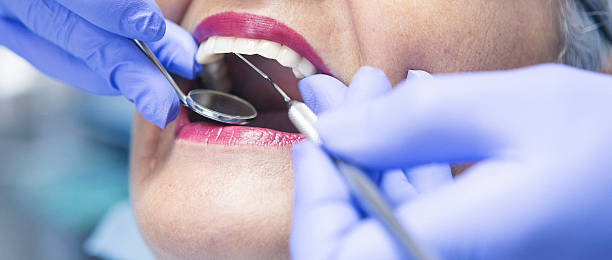Best Emergency Dentist for Lost Fillings or Crowns in Plymouth Meeting, PA